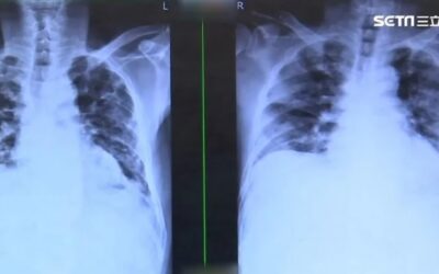 兒醫示警「人類間質肺炎病毒」無差別攻擊 恐共同感染