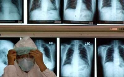 驚!別以為新冠無症狀沒事 肺部滿疤痕比吸菸還嚴重