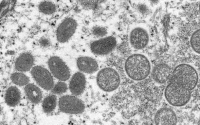 台現首例猴痘!胸腔醫揭2傳染途徑「死亡率最高10%」