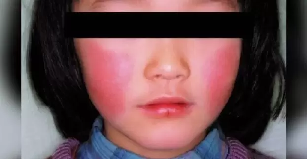 日旅注意！沖繩「蘋果病」疫情拉緊報！ 暫無抗病毒藥物可醫