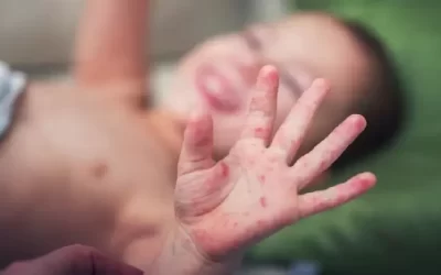 腸病毒疫情升溫破3500人 成人無症狀恐成傳染源、嬰幼兒重症風險高