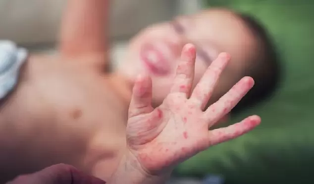 腸病毒疫情升溫破3500人 成人無症狀恐成傳染源、嬰幼兒重症風險高